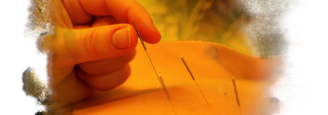 A photo of acupuncture