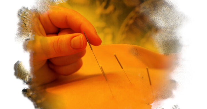 A photo of acupuncture